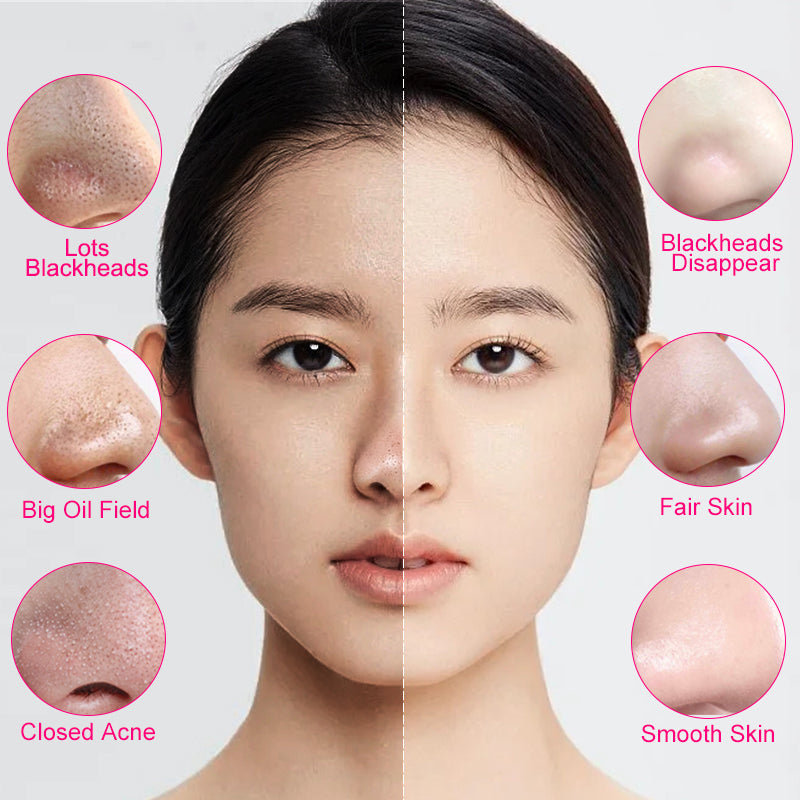 RtopR Mango Blackhead Mask