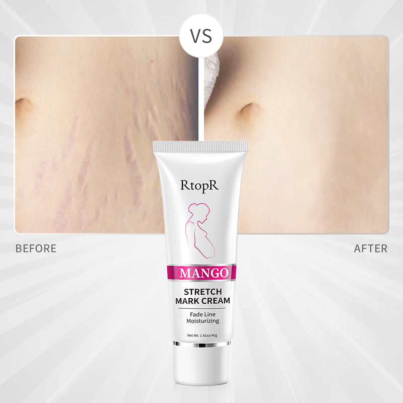 RtopR Mango Stretch Mark Cream